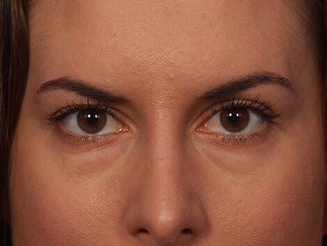 Injectable Fillers Before & After Image