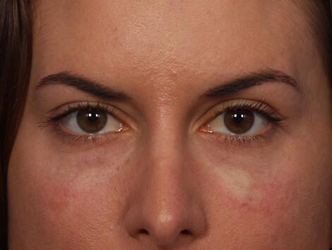 Injectable Fillers Before & After Image