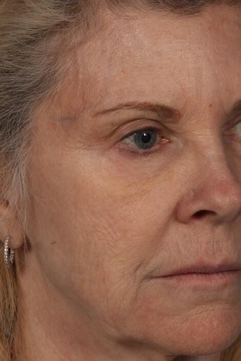 Injectable Fillers Before & After Image