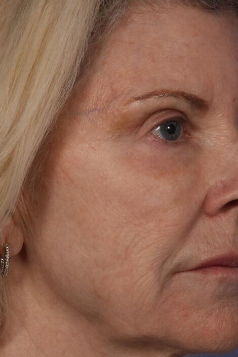 Injectable Fillers Before & After Image