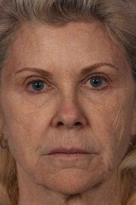 Injectable Fillers Before & After Image