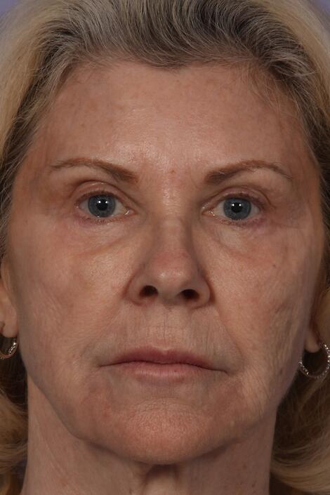 Injectable Fillers Before & After Image