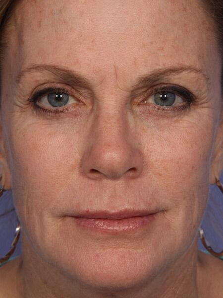 Injectable Fillers Before & After Image