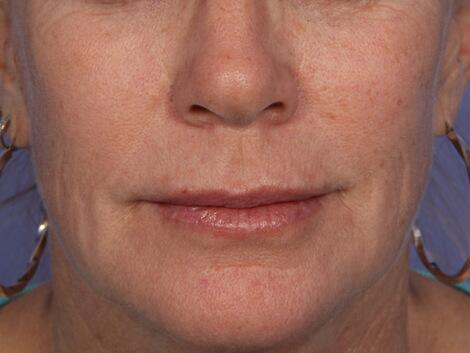 Injectable Fillers Before & After Image