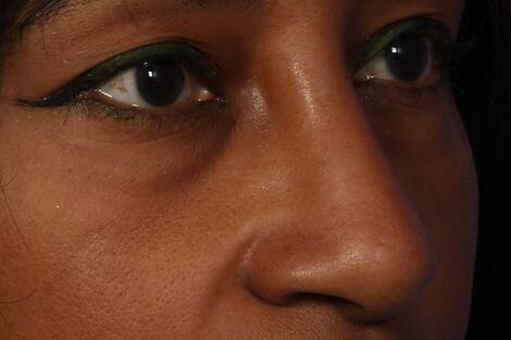 Injectable Fillers Before & After Image