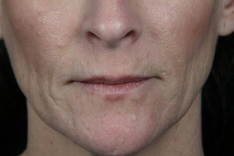 Injectable Fillers Before & After Image