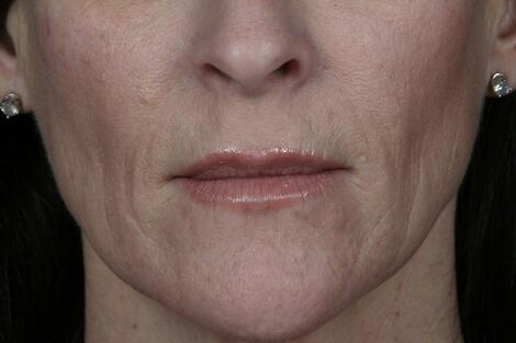 Injectable Fillers Before & After Image