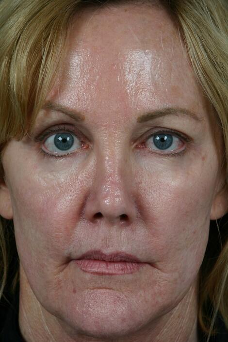 Injectable Fillers Before & After Image