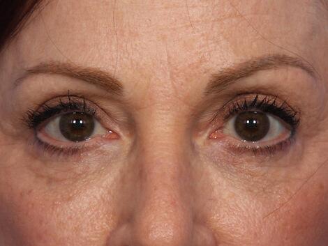 Injectable Fillers Before & After Image