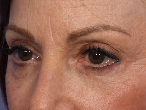 Injectable Fillers Before & After Image