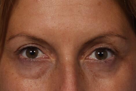 Injectable Fillers Before & After Image