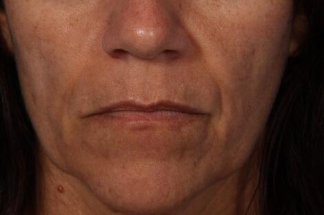 Injectable Fillers Before & After Image