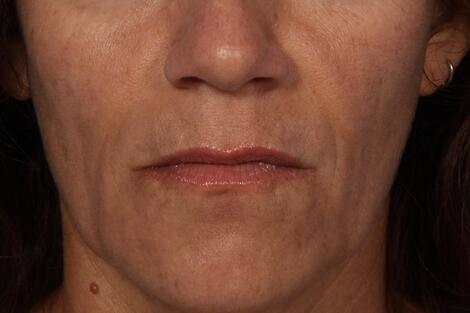 Injectable Fillers Before & After Image