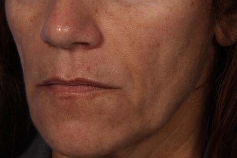 Injectable Fillers Before & After Image