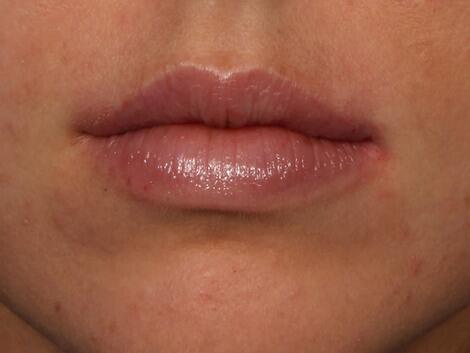 Injectable Fillers Before & After Image