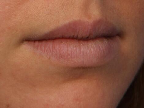 Injectable Fillers Before & After Image