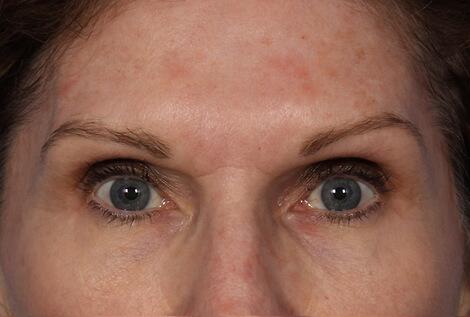 Injectable Fillers Before & After Image