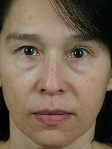 Injectable Fillers Before & After Image