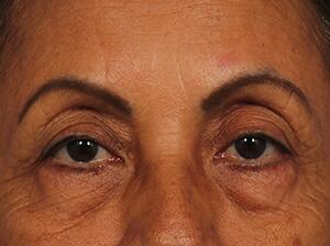 Injectable Fillers Before & After Image