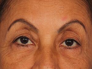 Injectable Fillers Before & After Image