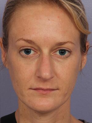 Injectable Fillers Before & After Image