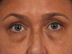 Injectable Fillers Before & After Image