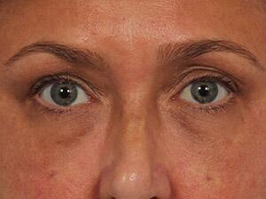 Injectable Fillers Before & After Image