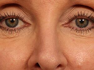 Injectable Fillers Before & After Image