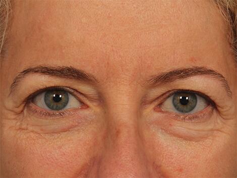 Injectable Fillers Before & After Image