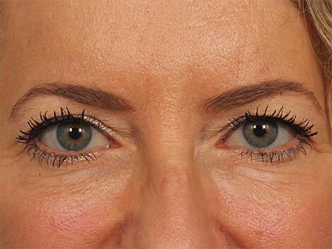 Injectable Fillers Before & After Image