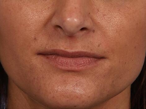 Injectable Fillers Before & After Image