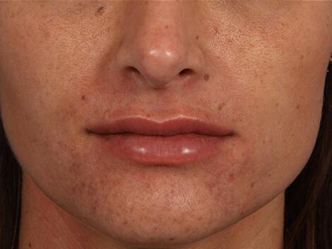 Injectable Fillers Before & After Image