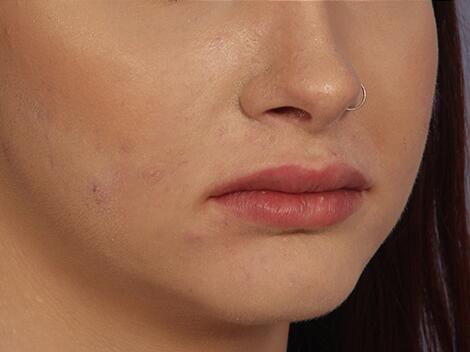 Injectable Fillers Before & After Image