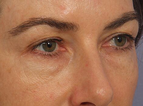 Injectable Fillers Before & After Image