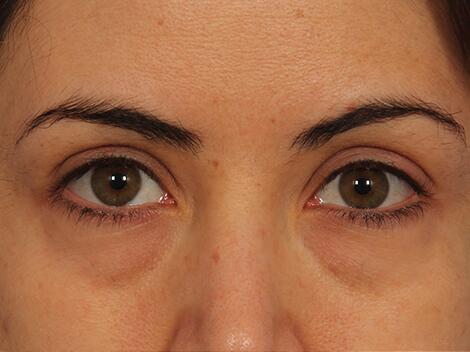 Injectable Fillers Before & After Image