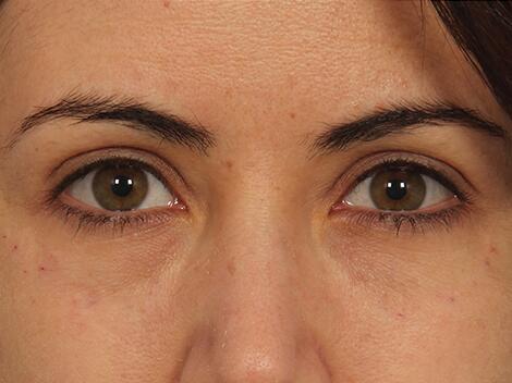 Injectable Fillers Before & After Image