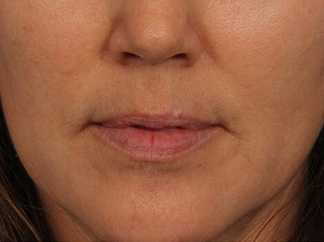 Injectable Fillers Before & After Image