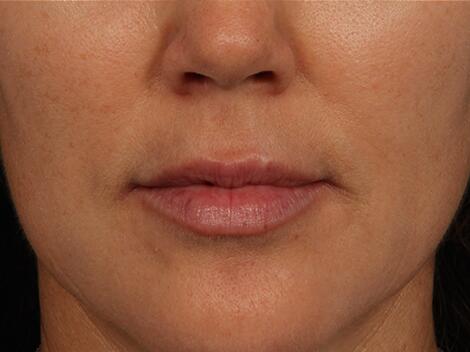 Injectable Fillers Before & After Image