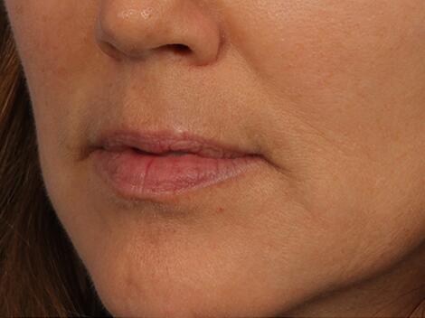 Injectable Fillers Before & After Image