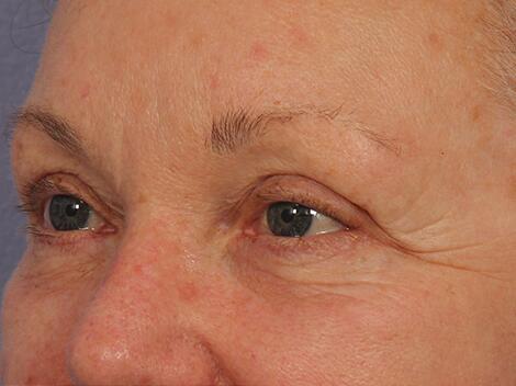 Injectable Fillers Before & After Image