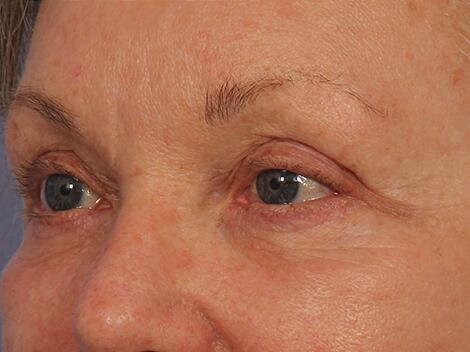 Injectable Fillers Before & After Image