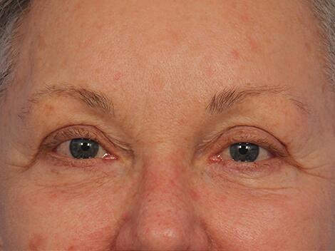 Injectable Fillers Before & After Image