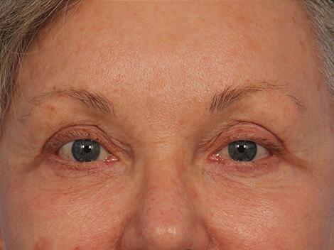 Injectable Fillers Before & After Image