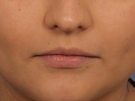 Injectable Fillers Before & After Image