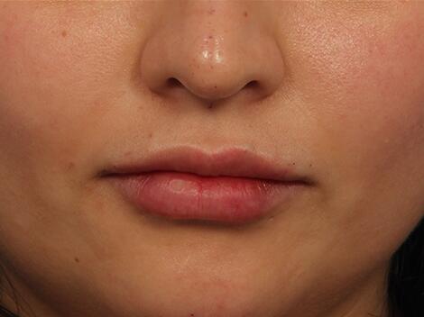 Injectable Fillers Before & After Image