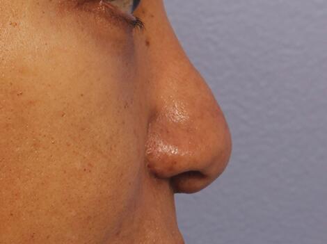 Injectable Fillers Before & After Image