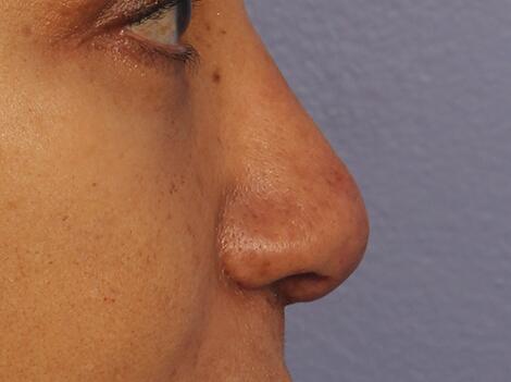 Injectable Fillers Before & After Image