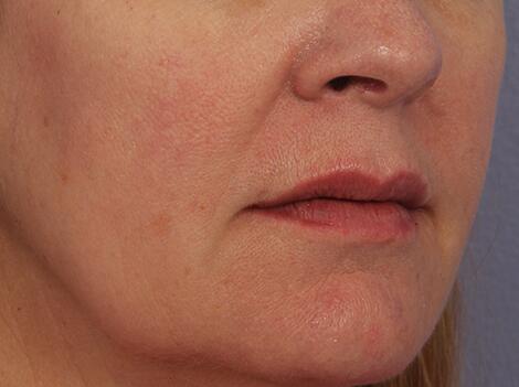 Injectable Fillers Before & After Image