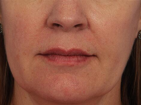 Injectable Fillers Before & After Image