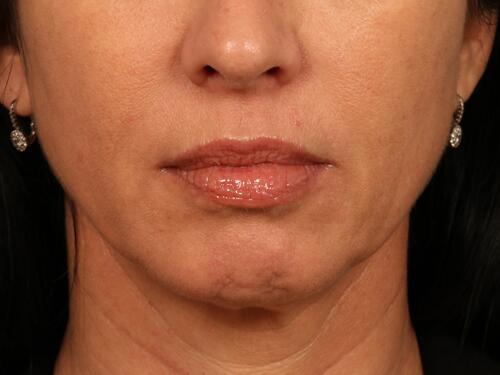 Injectable Fillers Before & After Image